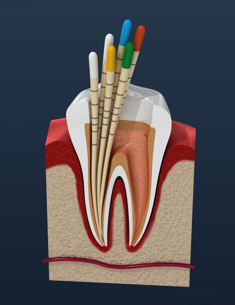 Endodontics Chestermere Station Pediatric Dentistry and Orthodontics